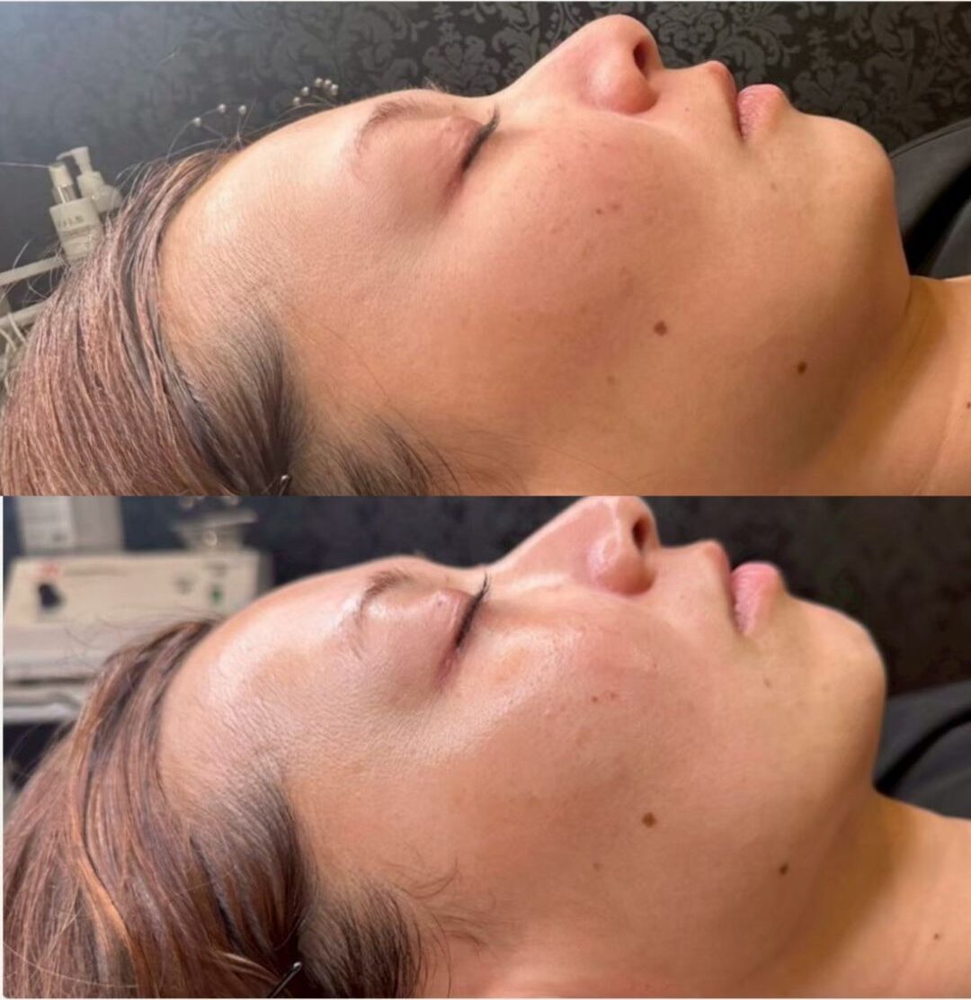 フェイシャルエステ施術